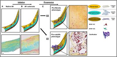 Dissecting Calcific Aortic Valve Disease—The Role, Etiology, and Drivers of Valvular Fibrosis